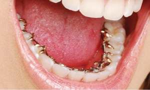 Orthodontie linguale