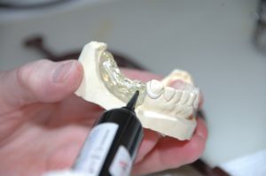 avantages colle dentaire