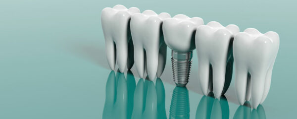 implants dentaires