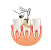 Les caries