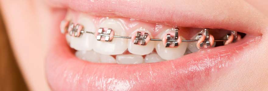 Orthodontie appareil dentaire