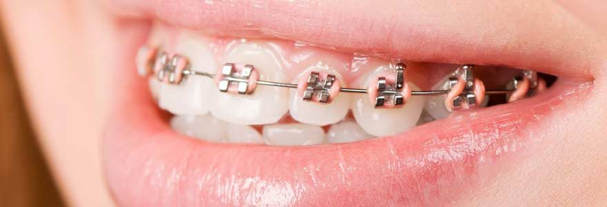 Orthodontie : quelles sont les solutions alternatives à l’appareil dentaire ?