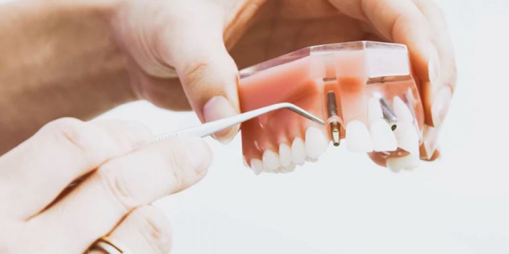 Implant dentaire : Comment optimiser ses remboursements ?