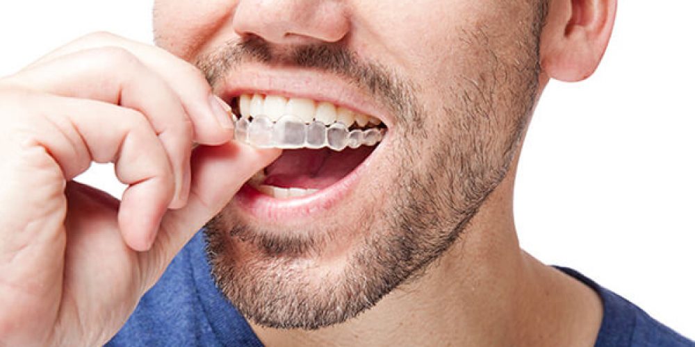 Quelles sont les solutions d’orthodontie invisible ?