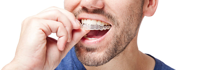 Solutions d’orthodontie invisible